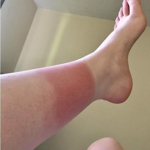 Житель Санкт-петербурга проснулся ночью от сильной боли в ноге, обнаружив, что его укусила супруга.  